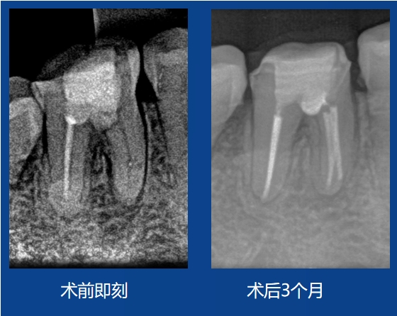 劉杰老師案例——髓室底穿孔修復