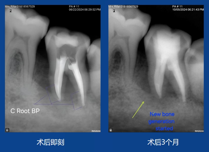 Sazzad Ur Rahman 老師案例——根吸收修復及充填
